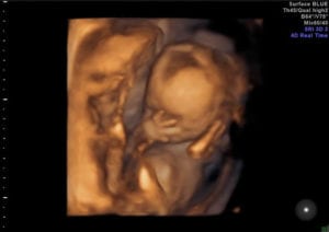Gravidez 17 semanas